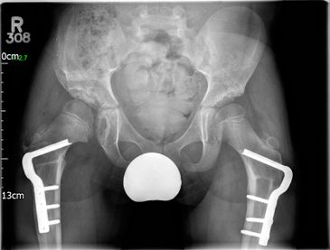 Dysplastic hips on a child after - JRB Orthopaedics