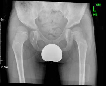 Dysplastic hips on a child before - JRB Orthopaedics