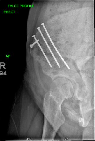 02 - Hip preservation after - JRB Orthopaedics