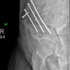 02 - Hip preservation after - JRB Orthopaedics