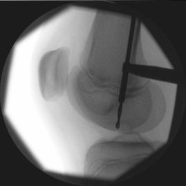 Adolescent Knee pain - SV IIx - Intraoperative Xray