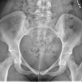 01 Hip preservation before - JRB Orthopaedics