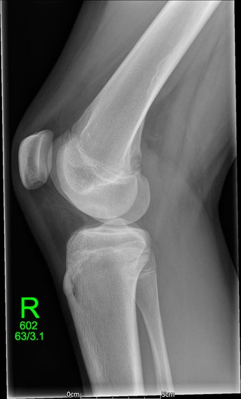 Adolescent Knee pain - SV post - post op (healed ) OCD