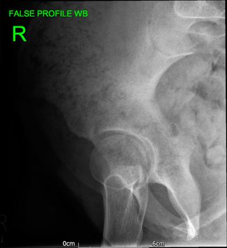 02 - Hip preservation before - JRB Orthopaedics