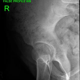 02 - Hip preservation before - JRB Orthopaedics