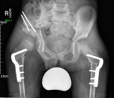 DFD Early post op - JRB Orthopaedics