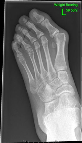 01 - Flat foot before - JRB Orthopaedics