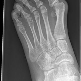 01 - Flat foot before - JRB Orthopaedics