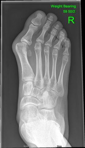 02 - Flat foot before - JRB Orthopaedics