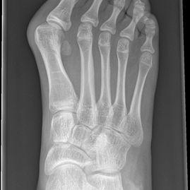 02 - Flat foot before - JRB Orthopaedics