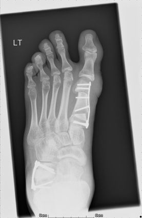 01 - Flat foot after - JRB Orthopaedics
