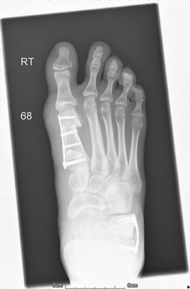 02 - Flat foot after - JRB Orthopaedics