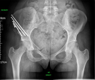 01 Hip preservation after - JRB Orthopaedics