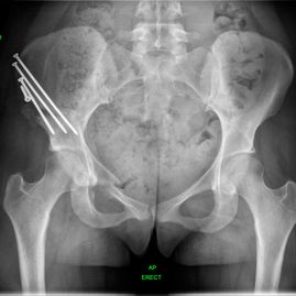 01 Hip preservation after - JRB Orthopaedics