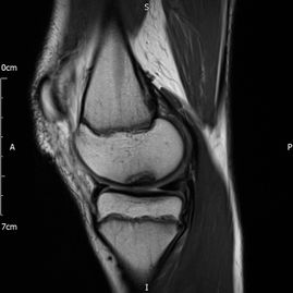 Adolescent Knee pain - SV pre MR - Pre-op MRI of OCD lesion
