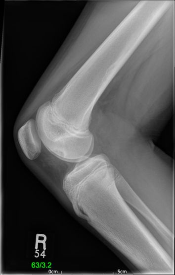 Adolescent Knee pain - SV pre - pre-op OCD lesion